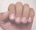 Dirty fingernails